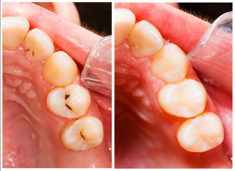 Composite-Tooth-Colored-Fillings