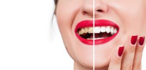 Before and after teeth whitening