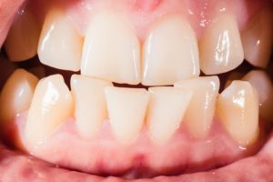 closeup of crooked teeth
