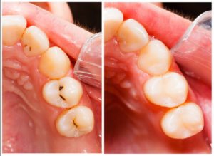 Composite-Tooth-Colored-Fillings