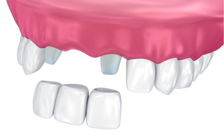 dental bridge