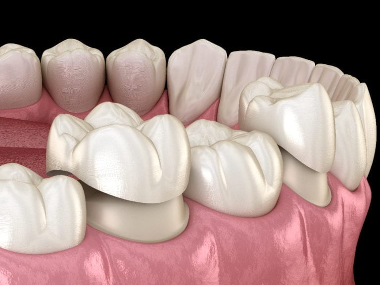 Rendered image of porcelain veneers