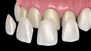 Porcelain Veneers