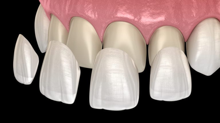 Porcelain Veneers