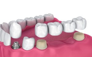 Dental Bridge