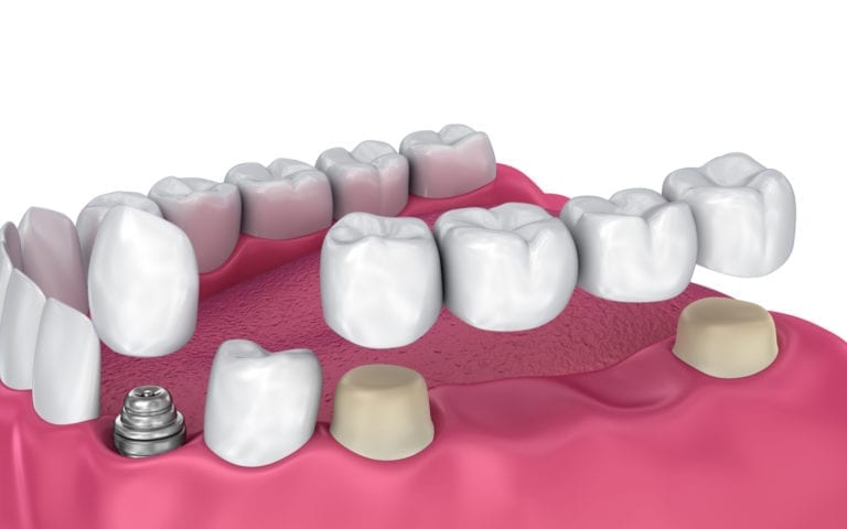Dental Bridge