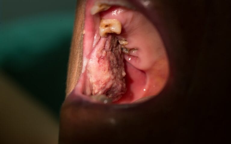 Man with oral cancer