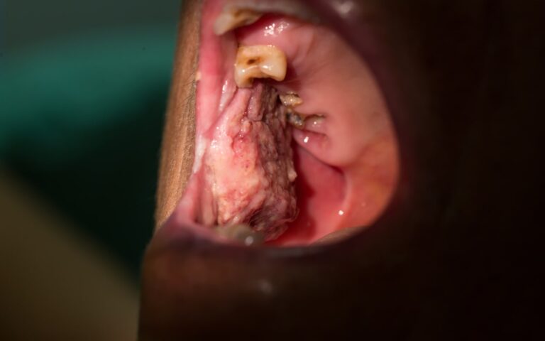 Oral Cancer